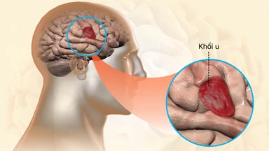 U nguyên bào thần kinh là gì? Nguyên nhân, triệu chứng và điều trị