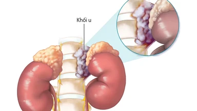 U nguyên bào thần kinh ở người lớn: Triệu chứng, chẩn đoán và điều trị