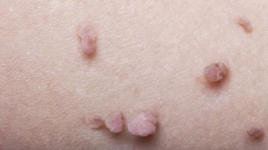 U nhú là gì? Nguyên nhân, triệu chứng và cách điều trị