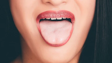 U nhú lưỡi là gì? Nguyên nhân, triệu chứng và cách điều trị
