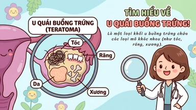 U quái buồng trứng là gì? Triệu chứng, nguyên nhân và khi nào cần phẫu thuật