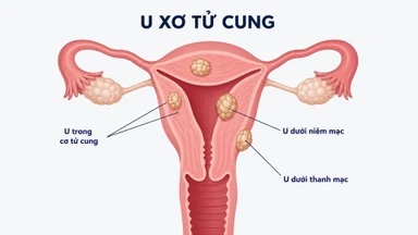 U xơ tử cung thoái hóa: Nguyên nhân, dấu hiệu và cách điều trị