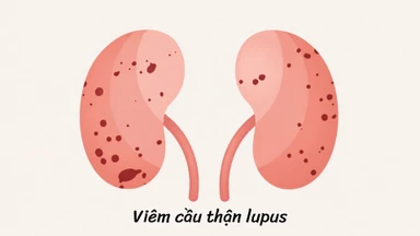 Viêm cầu thận lupus: Triệu chứng, nguyên nhân, chẩn đoán và điều trị
