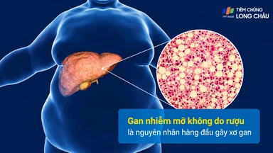Viêm gan nhiễm mỡ không do rượu: Nguyên nhân và cách phòng ngừa