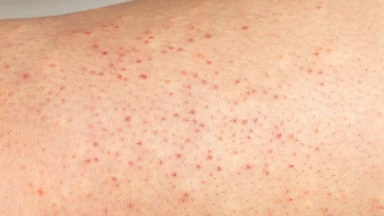 Viêm lỗ chân lông ở chân: Nguyên nhân và cách điều trị hiệu quả