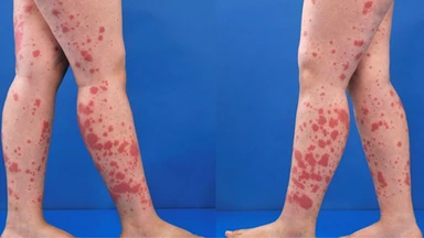 Viêm mao mạch dị ứng bao lâu thì khỏi? Điều trị bệnh như thế nào?