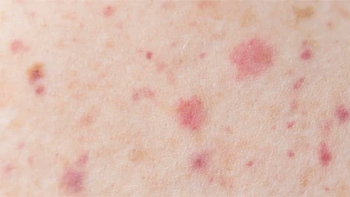 Viêm mao mạch dị ứng có chữa được không? 