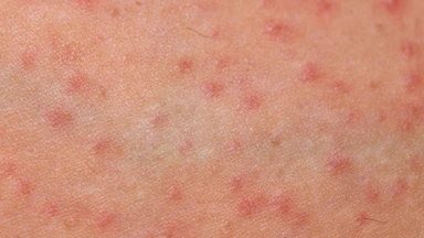 Viêm nang lông do nấm Malassezia: Dấu hiệu, nguyên nhân và cách điều trị