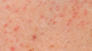 Viêm nang lông Malassezia: Nguyên nhân, triệu chứng và cách điều trị