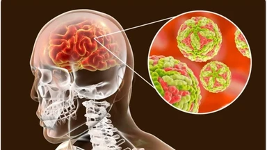 Viêm não Nhật Bản có chữa được không? Tiên lượng và cách điều trị