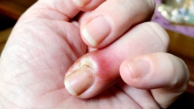 Viêm quanh móng: Nguyên nhân, dấu hiệu nhận biết và cách chăm sóc đúng