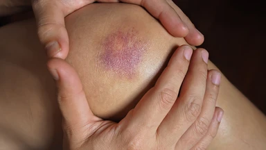 Vỡ mạch máu dưới da: Nguyên nhân, dấu hiệu và khi nào cần gặp bác sĩ?