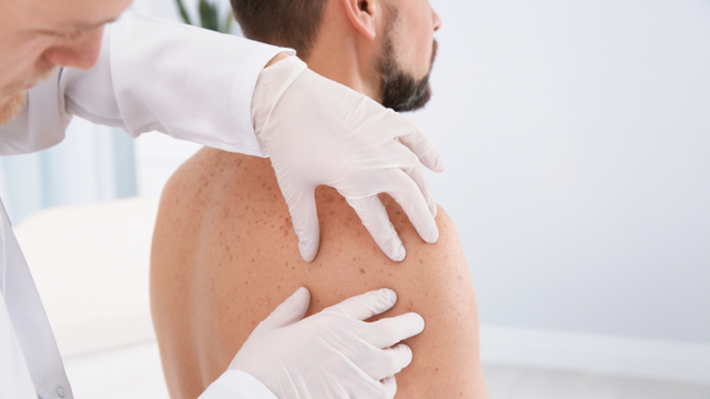 10 cách trị mụn nhọt và những lưu ý quan trọng