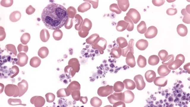 Tăng tiểu cầu có phải là ung thư máu? Nguyên nhân và cách nhận biết