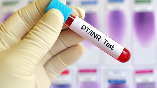 Xét nghiệm INR là xét nghiệm gì và khi nào cần thực hiện?