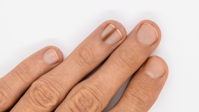 Móng tay bị thâm đen là bệnh gì? Những nguyên nhân thường gặp