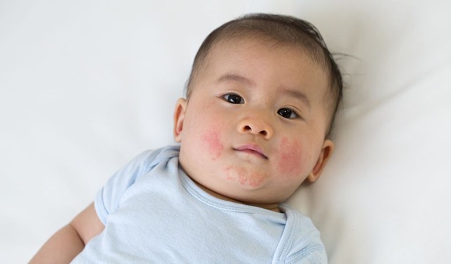 Trẻ sơ sinh bị rôm sảy ở mặt do nguyên nhân gì? Cách xử lý an toàn