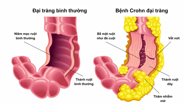 Bệnh Crohn đại tràng: Triệu chứng, phương pháp điều trị và phòng ngừa