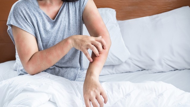 9 cách chữa mẩn ngứa mùa hè tại nhà an toàn, hiệu quả và dễ áp dụng