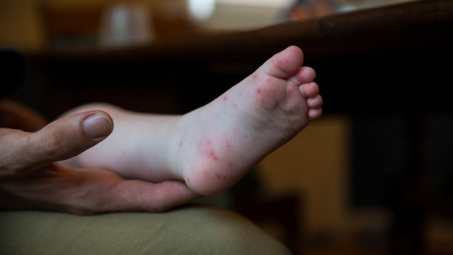 Mùa tay chân miệng cao điểm vào tháng mấy? Cách phòng ngừa