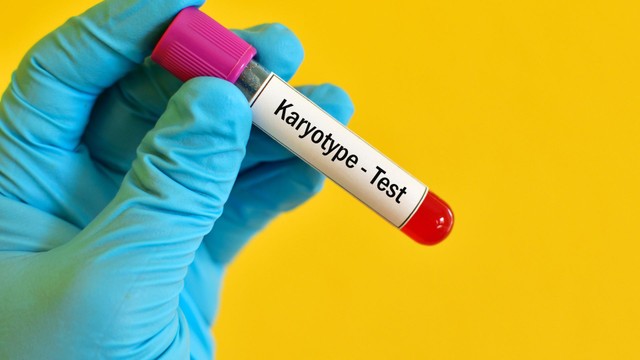 Karyotype là gì? Ứng dụng xét nghiệm karyotype trong chẩn đoán và điều trị hiếm muộn