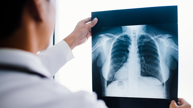 Bạn biết gì về tràn dịch màng phổi có vách ngăn không? 