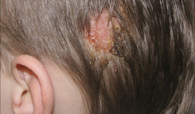 Bệnh nấm da đầu có lây không? Nguyên nhân và cách phòng ngừa