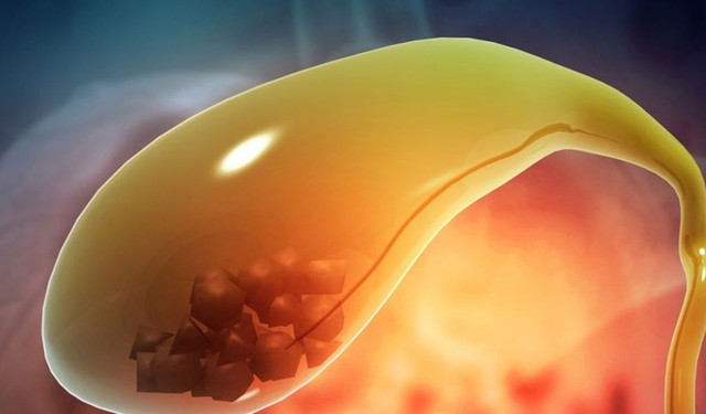 Sỏi cholesterol túi mật là gì? Nguyên nhân và cách phòng ngừa