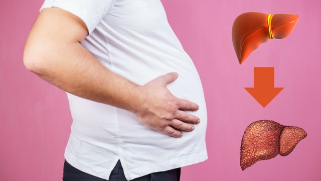 Xơ gan cổ trướng có lây không? Hiểu rõ bệnh để phòng ngừa hiệu quả