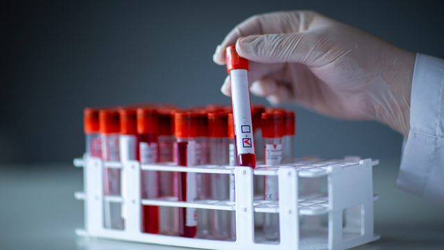 ASLO dương tính có sao không? Những lưu ý cần biết khi xét nghiệm