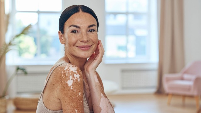 Bệnh bạch biến có nguy hiểm không? Hướng điều trị hiệu quả