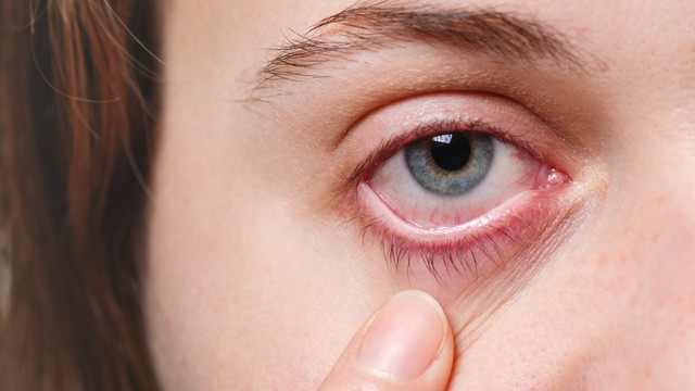 Bạch hầu ở mắt: Nguyên nhân, dấu hiệu, điều trị và phòng ngừa