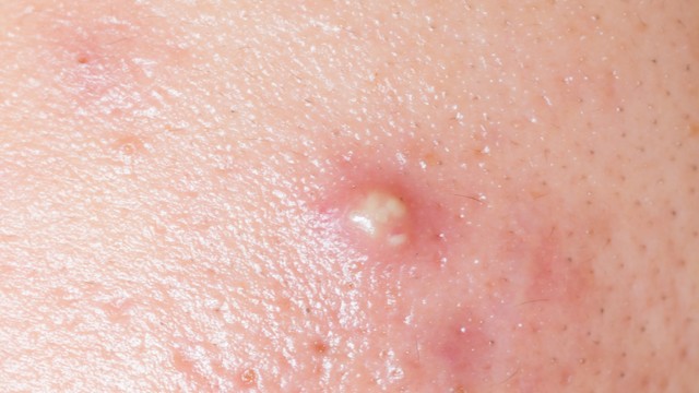 Bật mí những cách trị mụn bọc sưng đỏ đơn giản và hiệu quả