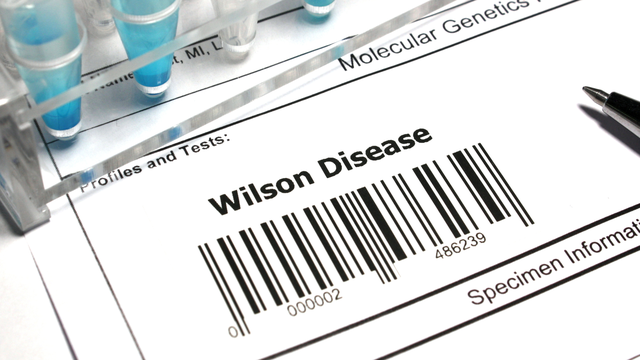 Bệnh Wilson là gì? Triệu chứng, nguyên nhân, cách điều trị và phòng ngừa