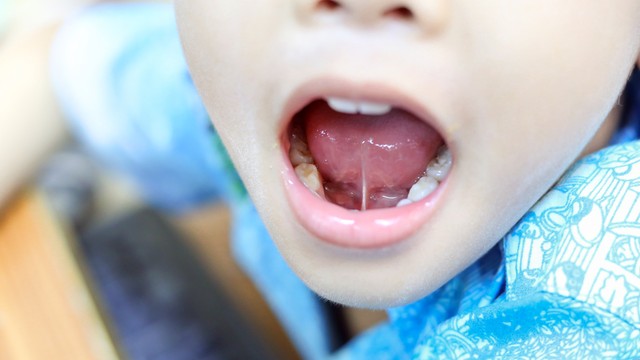 Dính thắng lưỡi là gì? Những vấn đề cần biết về dính thắng lưỡi