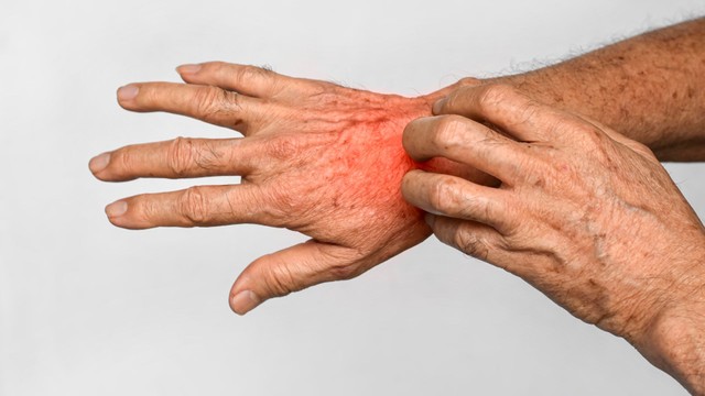 Bệnh ghẻ là gì? Những vấn đề cần biết về bệnh ghẻ