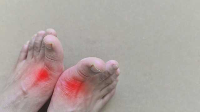 Bệnh gout là gì? Những điều cần biết về bệnh gout