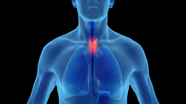 Hẹp thực quản là gì? Triệu chứng, nguyên nhân và cách điều trị