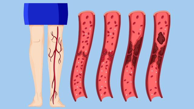 Huyết khối tĩnh mạch là gì? Nguyên nhân, triệu chứng và cách điều trị