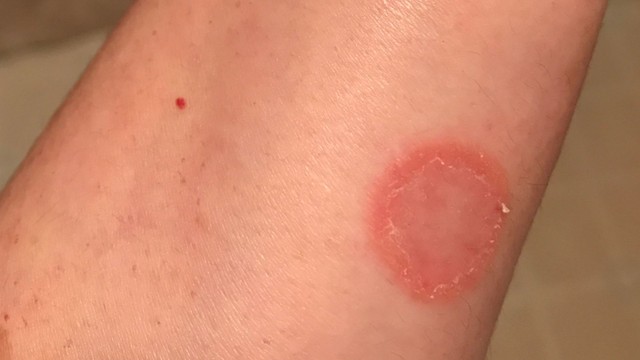 Lác đồng tiền là gì? Những điều cần biết về lác đồng tiền