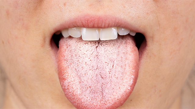 Lưỡi trắng là gì? Triệu chứng, nguyên nhân, cách điều trị và phòng ngừa