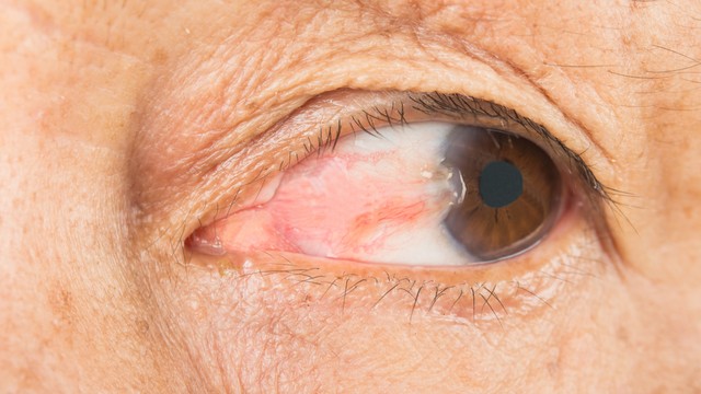 Mộng mắt: Dấu hiệu, nguyên nhân, phương pháp chẩn đoán, điều trị và phòng ngừa