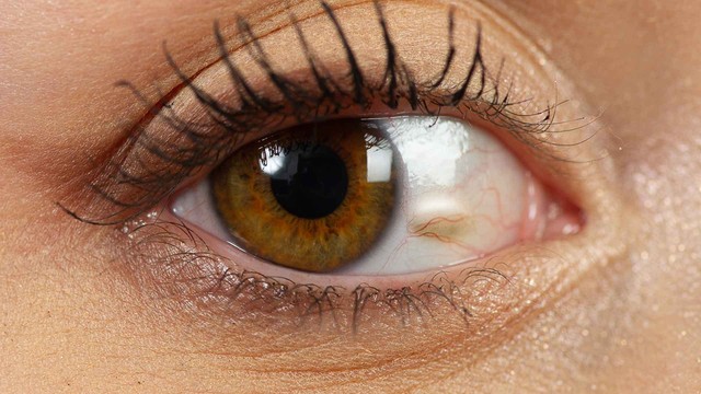 Mộng mỡ mắt là gì? Nguyên nhân và cách phòng ngừa hiệu quả