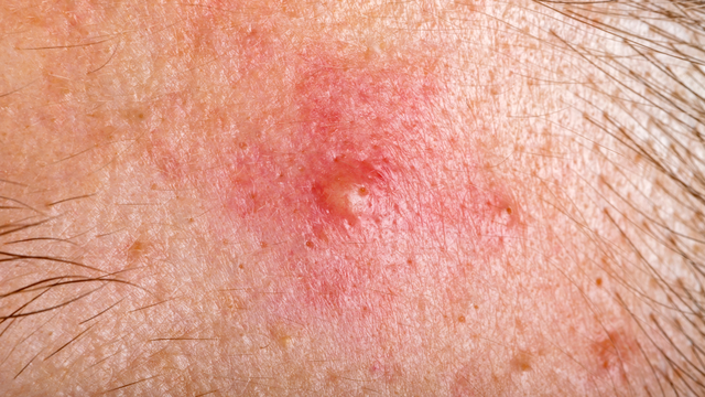 Mụn bọc là gì? Nguyên nhân, phương pháp điều trị và phòng ngừa