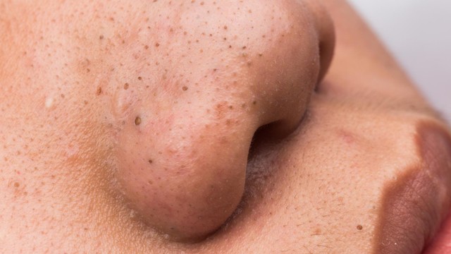 Mụn đầu đen: Nguyên nhân, cách điều trị và phòng ngừa tái phát