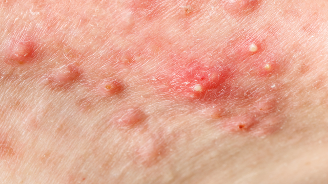 Mụn viêm: Nguyên nhân, cách điều trị và phòng ngừa tái phát