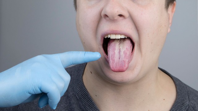 Nấm lưỡi là gì? Những vấn đề cần biết về bệnh nấm lưỡi