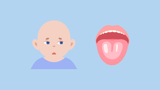 Nấm miệng là gì? Triệu chứng, cách điều trị và phòng ngừa lây nhiễm