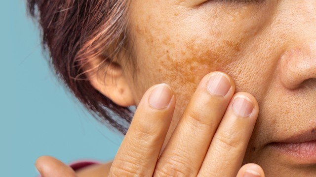 Nám nội tiết: Dấu hiệu, nguyên nhân, phương pháp chẩn đoán, điều trị và phòng ngừa