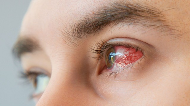 Rách giác mạc là gì? Những điều cần biết về rách giác mạc